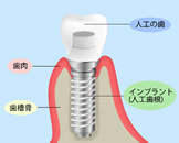 インプラント