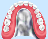 義歯（入れ歯）